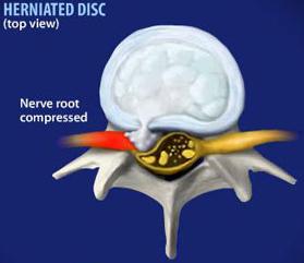 herniated disc in dogs herniated disc symptoms in dogs herniated disc in dogs herniated disc symptoms in dogs
