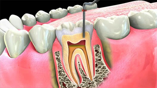 traitement radiculaire dentaire