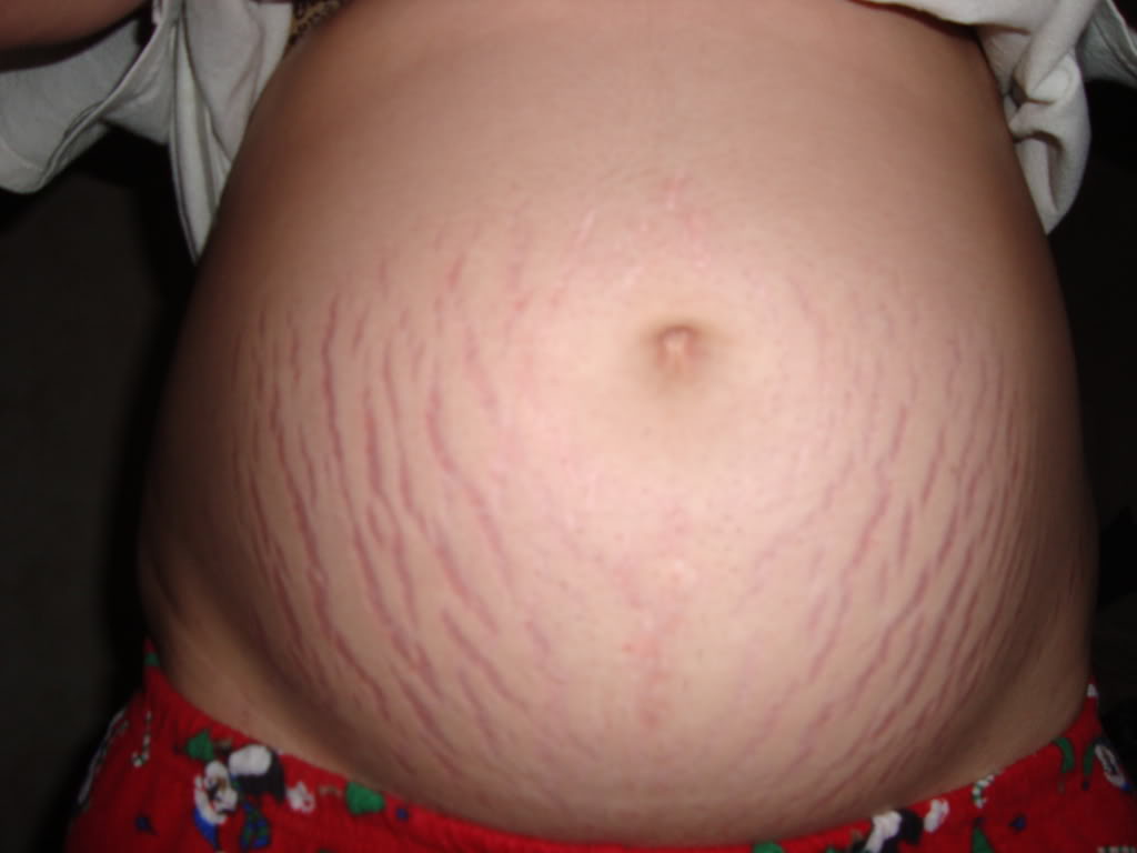 babes and baby what can i do about stretch marks how do stretch marks form