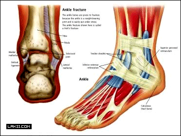 Deltoid Ligament Ankle Sprain التواء الكاحل بالرباط الدالي