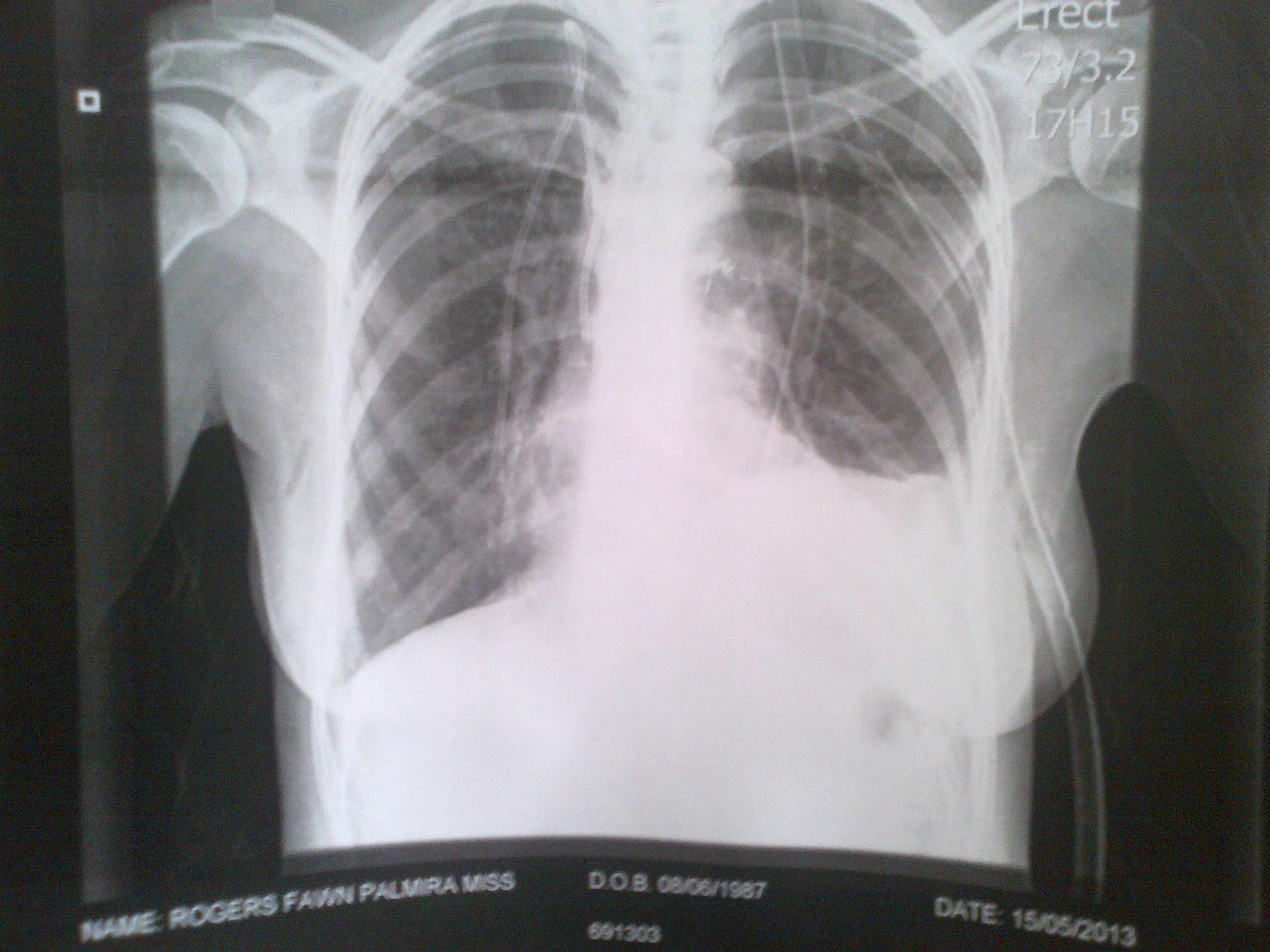 Deer Diary Punctured Lungs