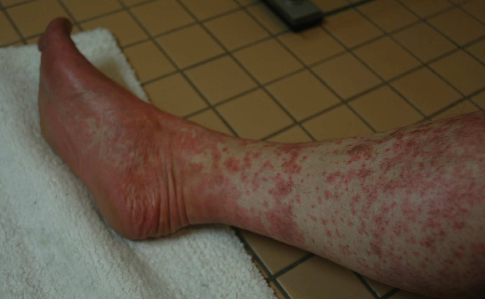 Atripla Rash Pictures