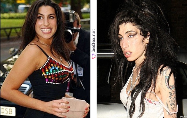 Φωτογραφίες Διάσημων Πριν Και Μετά Τα Ναρκωτικά