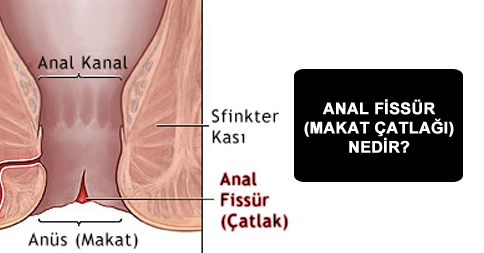 makat catlagi tedavisi blogger