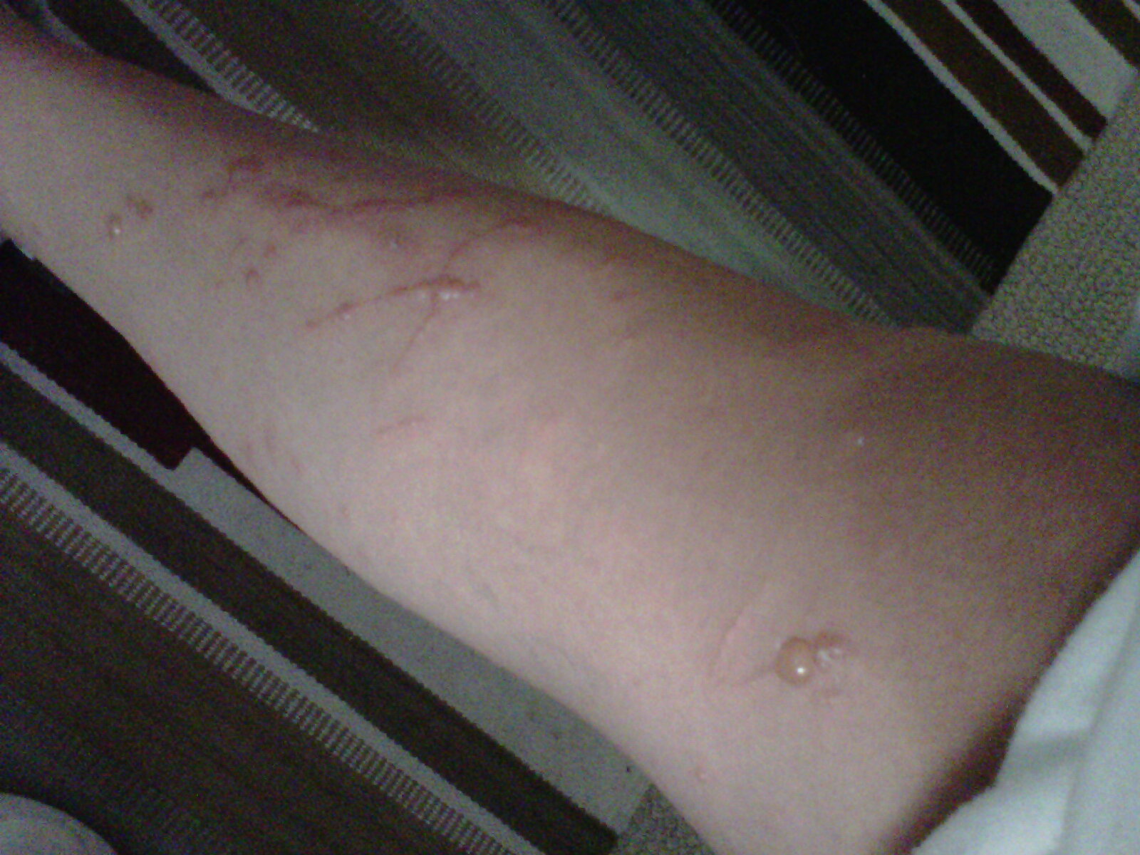 Poison Ivy...what a nightmare!