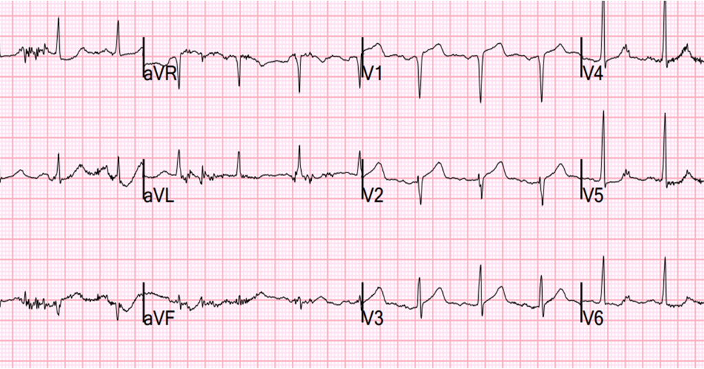 Dr  Smith U0026 39 S Ecg Blog  Septal Stemi With Lateral St