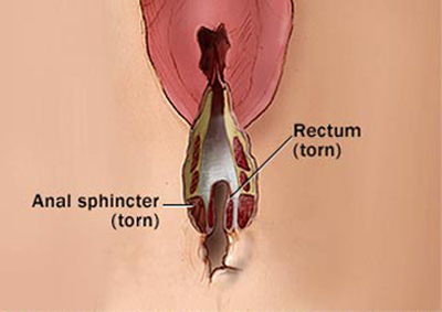 How To Treat Vaginal Tears