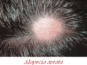 Topical steroids alopecia areata