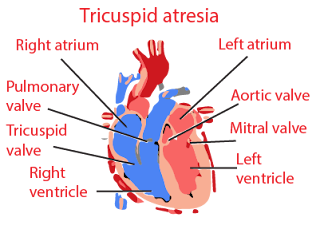 Tricuspid atresia