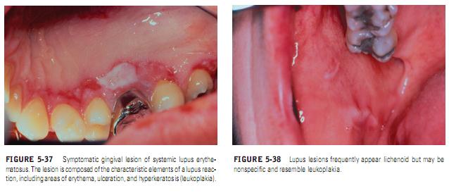 Burket S Oral Medicine Lupus Erythematosus Systemic And Discoid