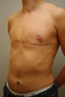 after breast removal surgery photos