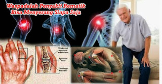 Rheumatoid Arthritis, rematik artritis, RA