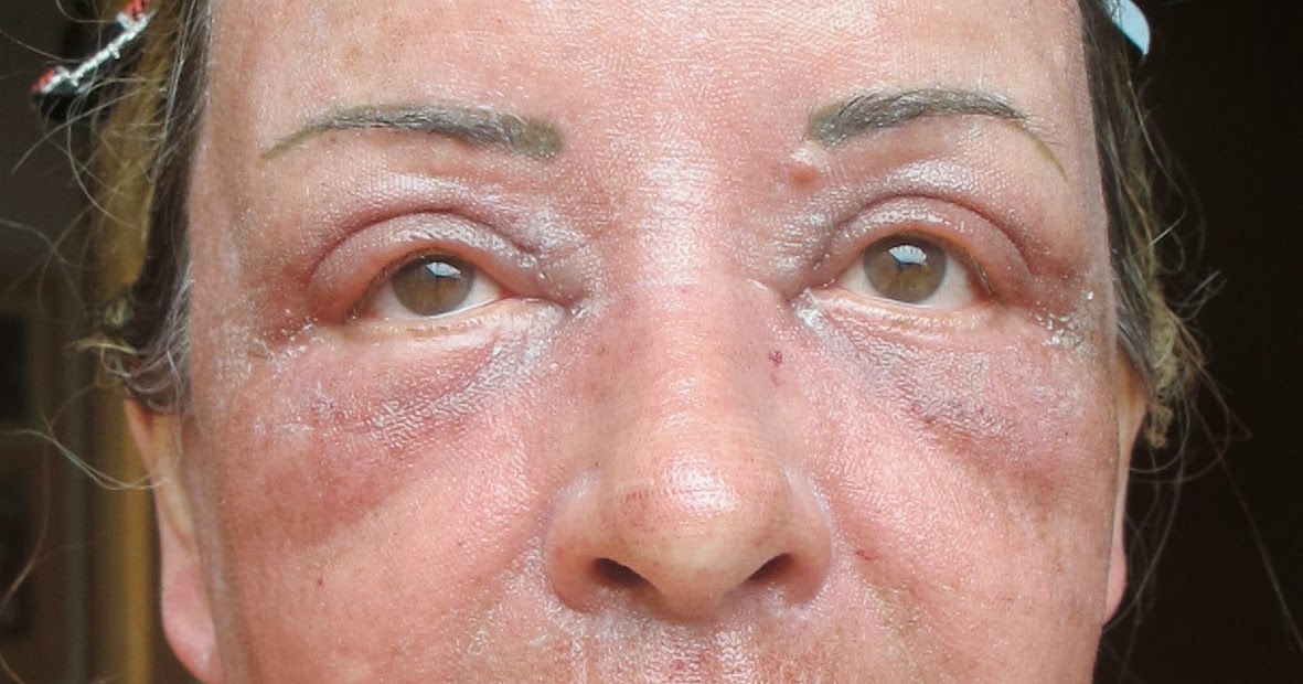 Edna Perfeitamente Imperfeita Laser de cO2 Fracionado