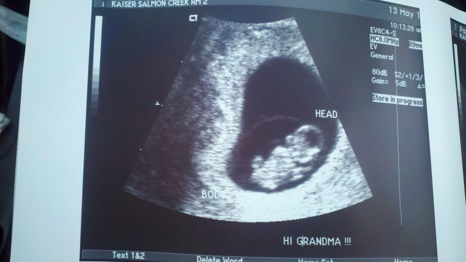 dating ultrasound 8 weeks