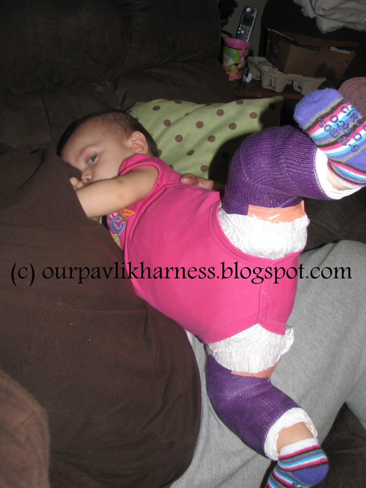 Our Pavlik Harness and journey with Hip Dysplasia Feeding the Spica