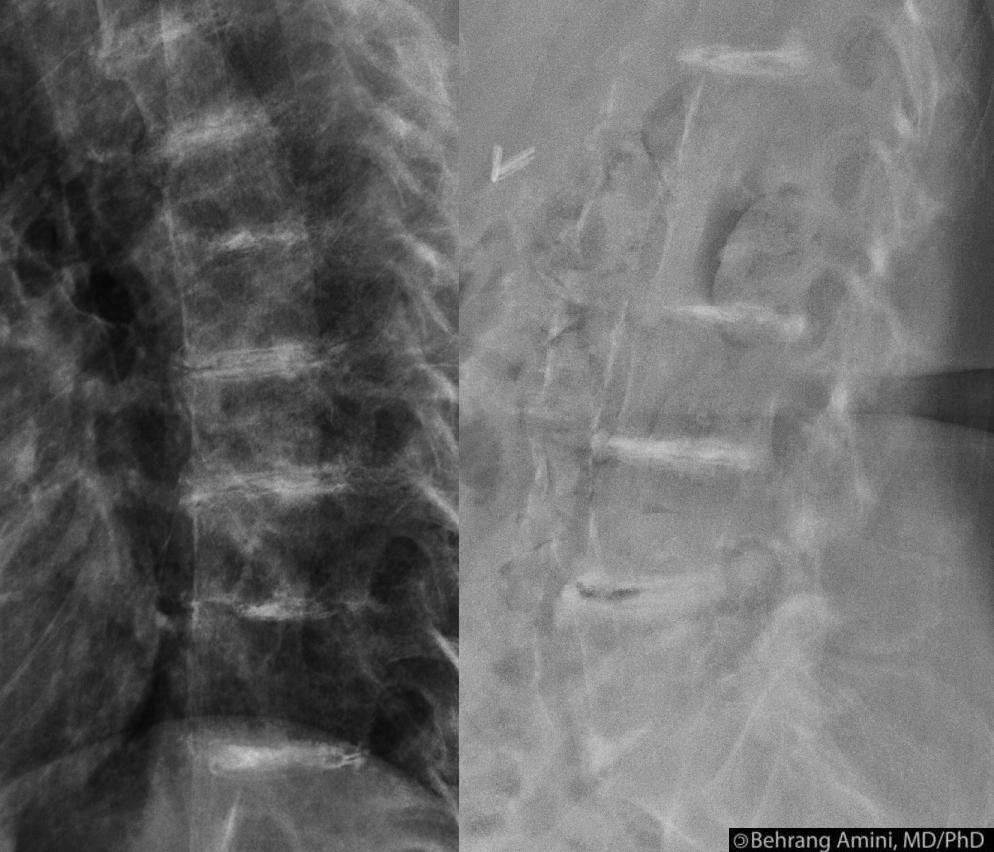 Alkaptonuria Pathway