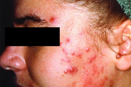Medical Pictures Info \u2013 Body Acne