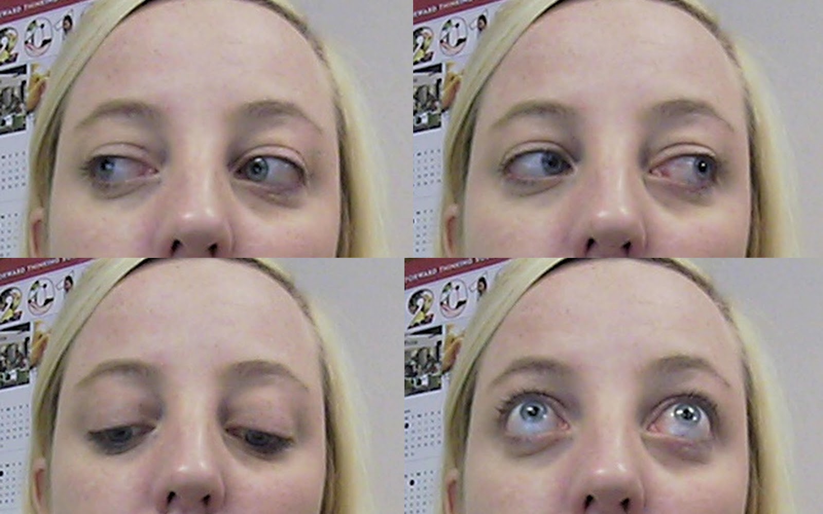 my eyes is the mirror of my heart Thyroid Eye Disease