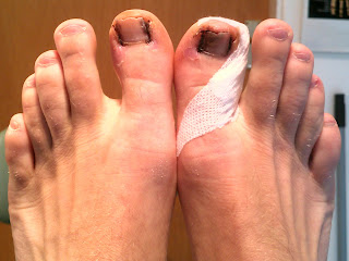 Hammer Toe