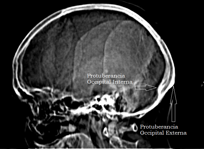 El Baúl Radiológico PROTUBERANCIA OCCIPITAL EXTERNA (Ossified Spur on