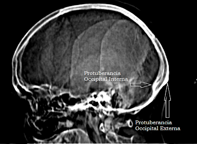 Protuberancia+7.png