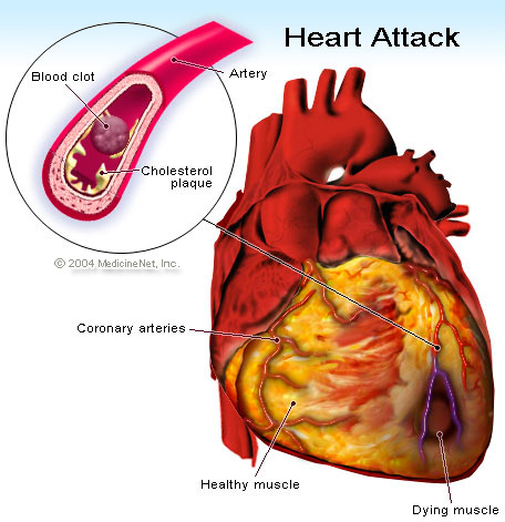 Ataque Cardiaco Causas Y Tratamiento
