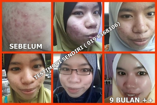 fantabulous, Fantabulous beaute, fantabulous skincare, jeragat, jerawat, jerawat batu, jerawat bernanah, jerawat halus, kulit berminyak, kulit gelap, kulit kering, kulit kusam, testimoni fantabulous 