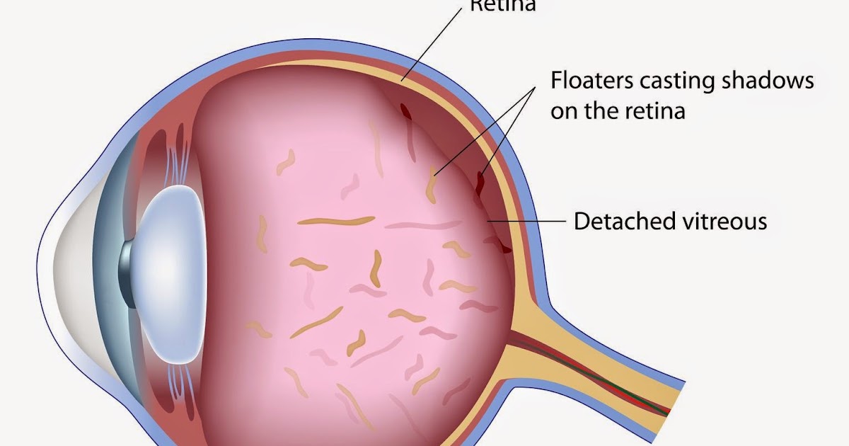 Eye Floaters Review How To Remove Eye Floaters? Vitamins For Eye Floater