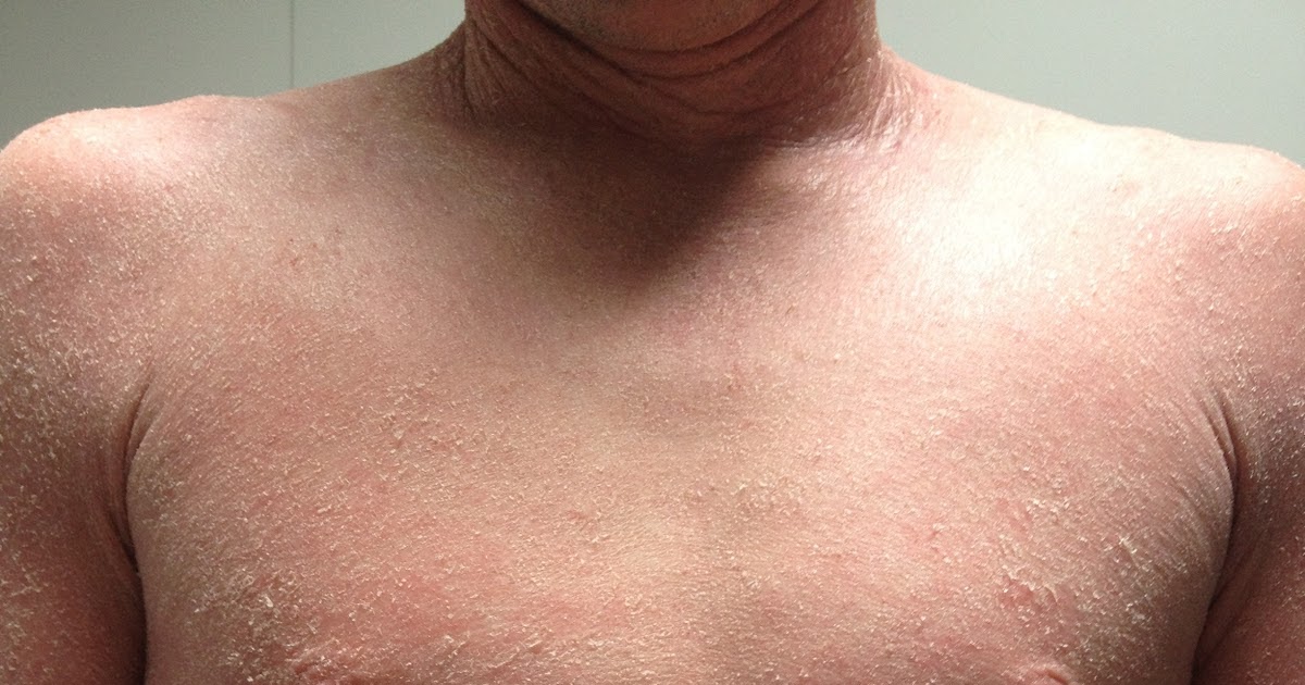 Healing Eczema and Cortisone Withdrawal Symptoms Inconsistency and