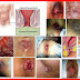 Buang Air Besar (BAB) Keluar Darah Menetes thumbnail