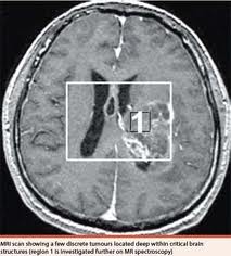 mri scan images of brain tumor Photos real pictures clear