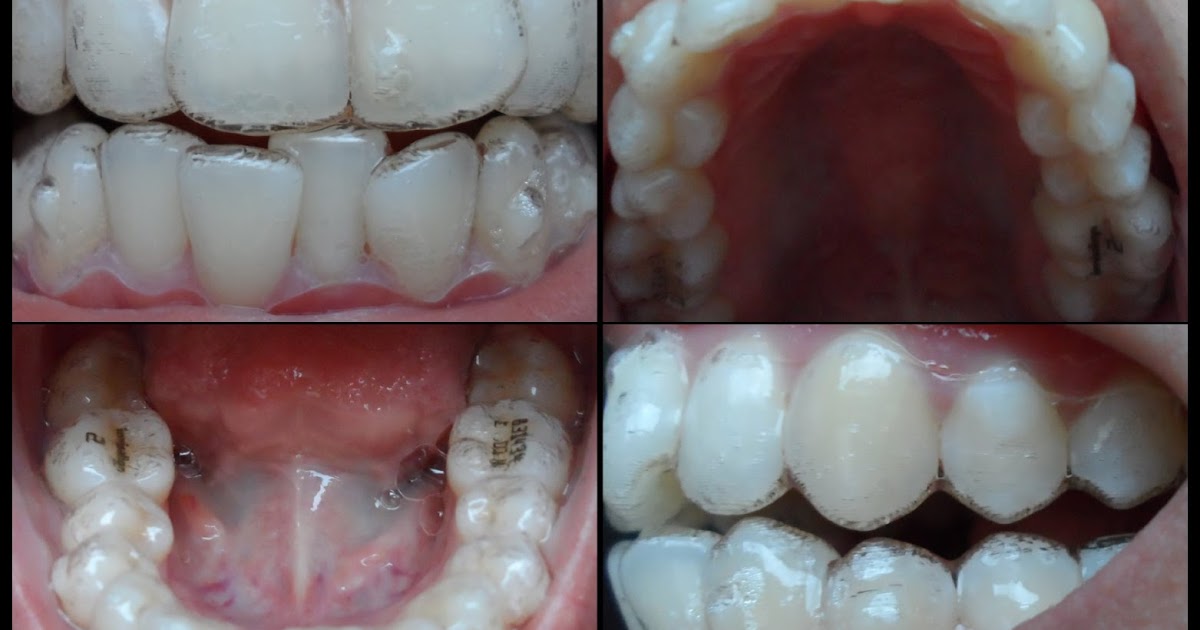 Ana's Invisalign Journey Tray 1 with Attachments/Buttons