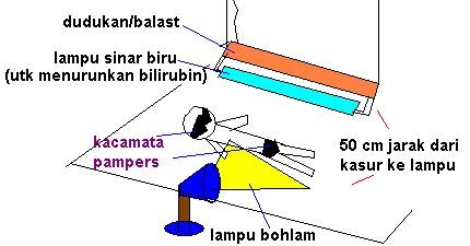Bayi Kuning & Cara Merawat Di Rumah