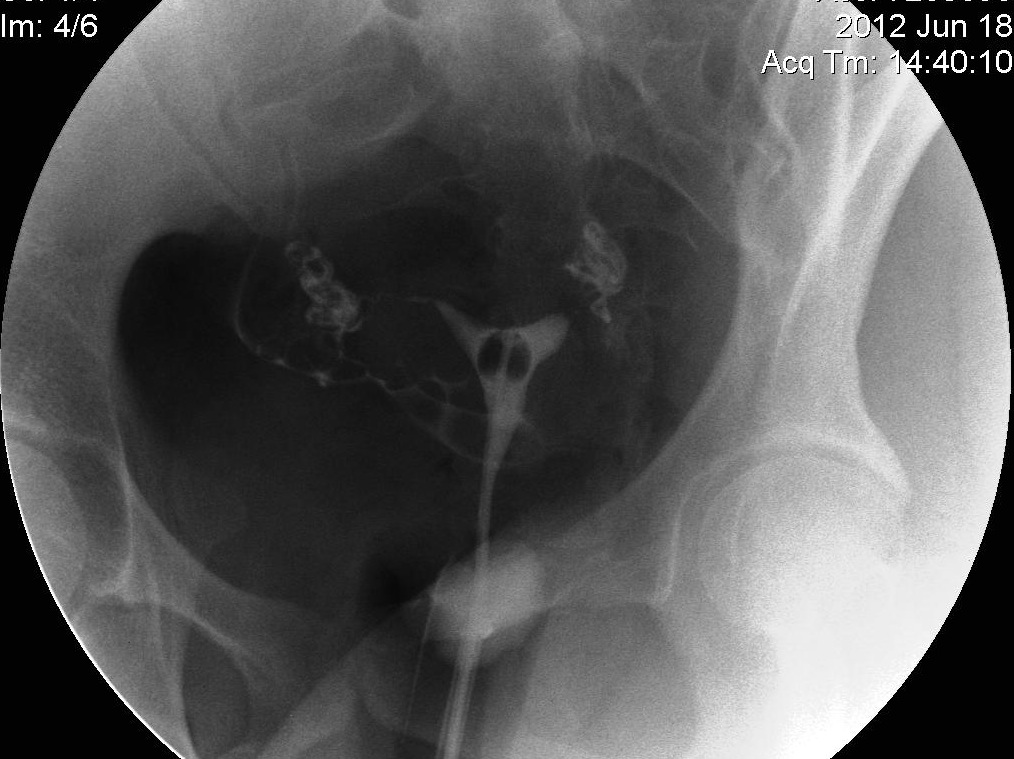 Dye Test To Check Fallopian Tubes at Sonja Rivera blog