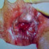 Obat wasir eksternal dan wasir thrombosed