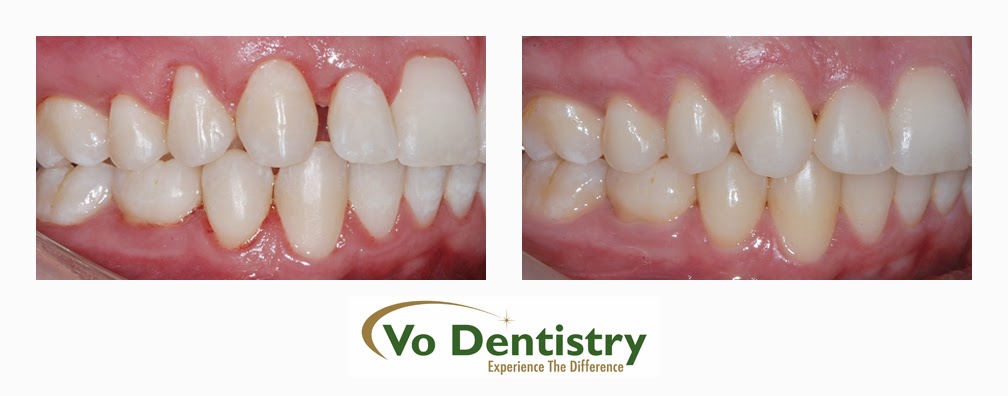 Tooth colored restorations, Vo Dentistry, Lawrenceville, GA 30043