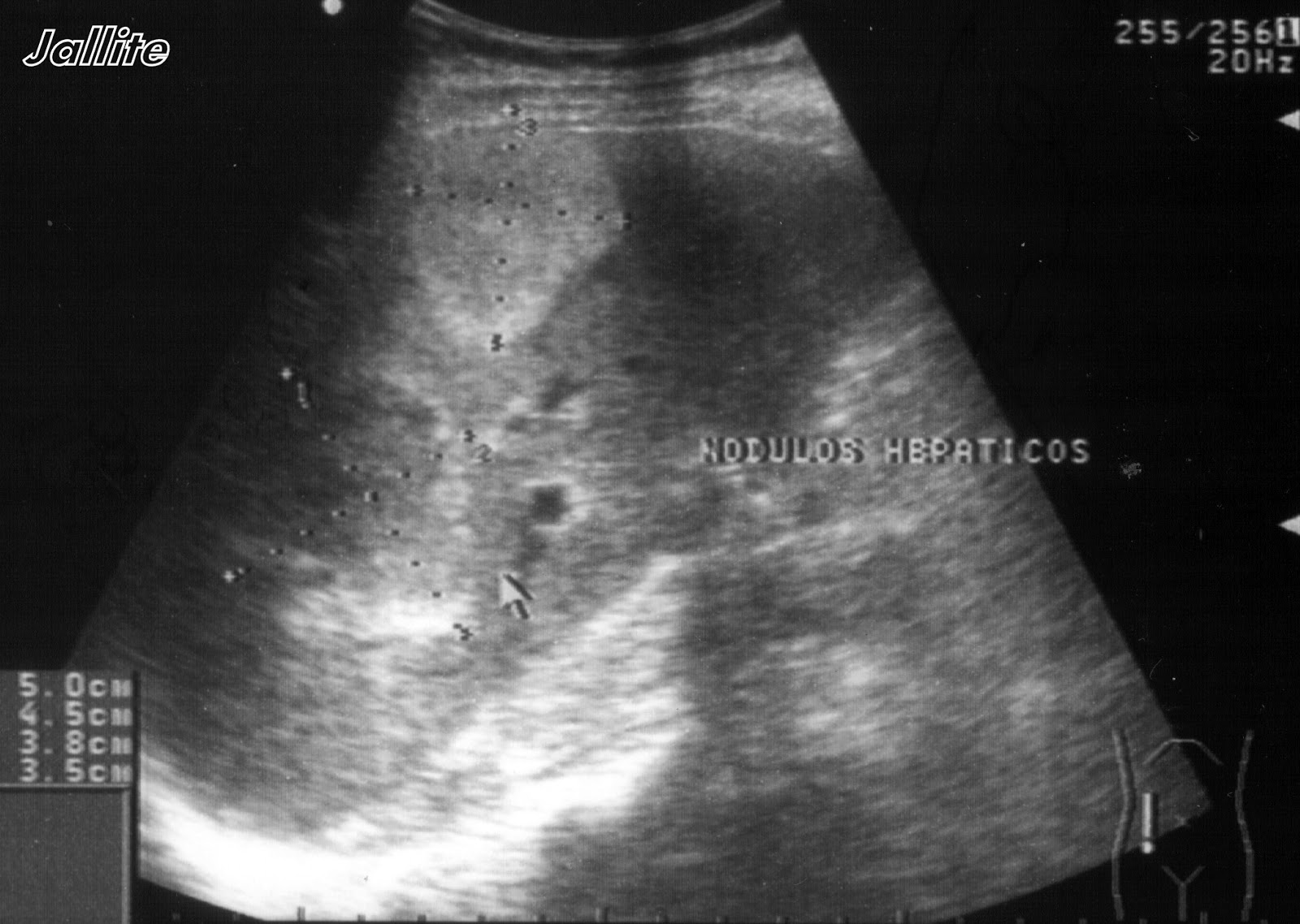 Nodulos Hepaticos y Lupus