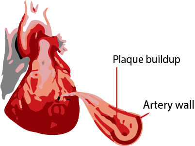 Acute Myocardial Infarction - Heart Attack
