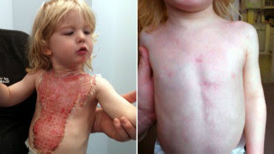 Skin Burn Treatment Natural Remedy Skin Burn Treatment Natural Remedy