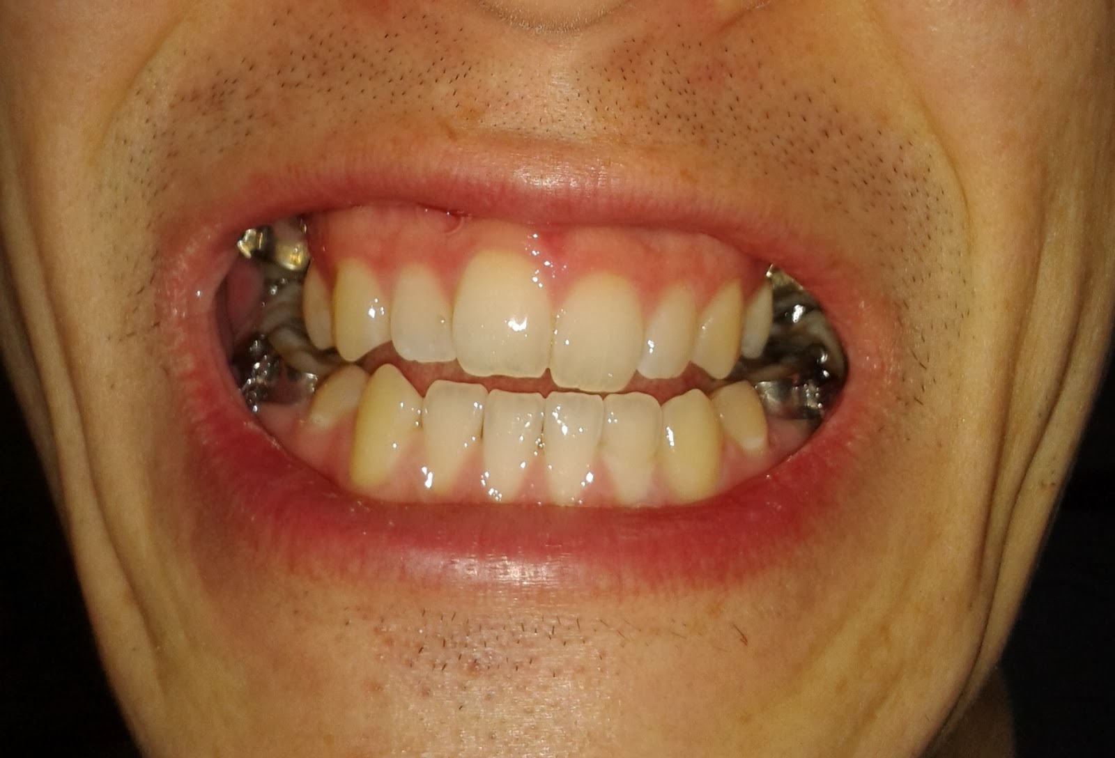 Fixing My Underbite The issue