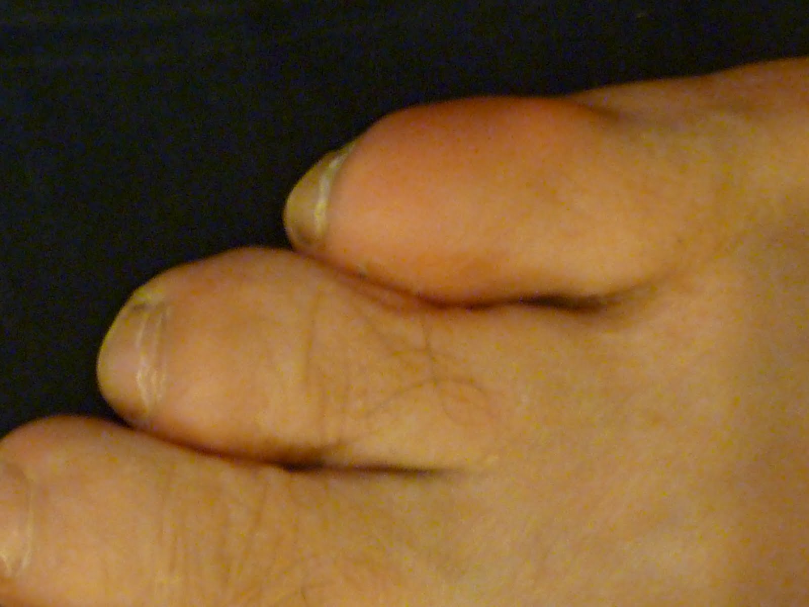 Hammertoe