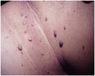 LESIONES EN EL CUELLO UTERINO lesiones en el cuello uterino: