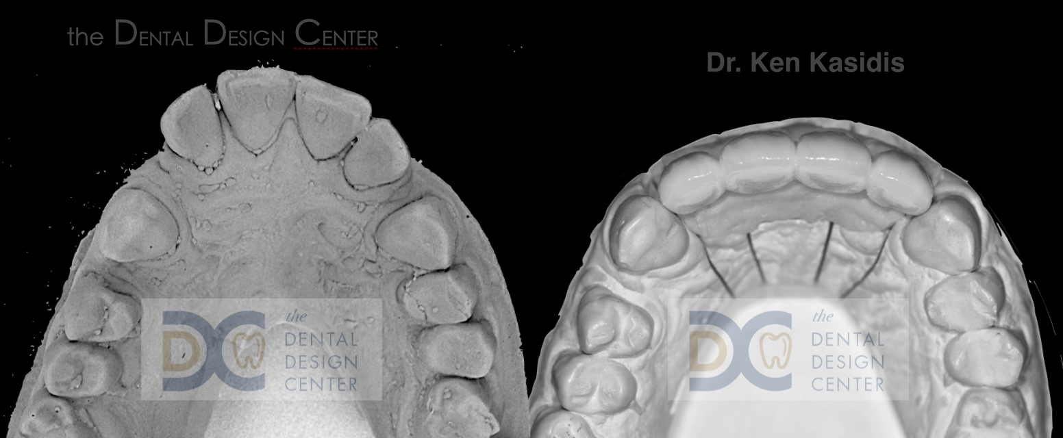 Correction of anterior protrusion with dental implants Dental Design