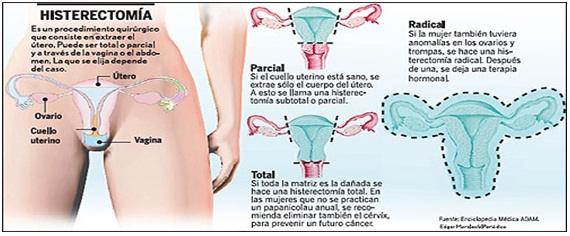 HISTERECTOMIA