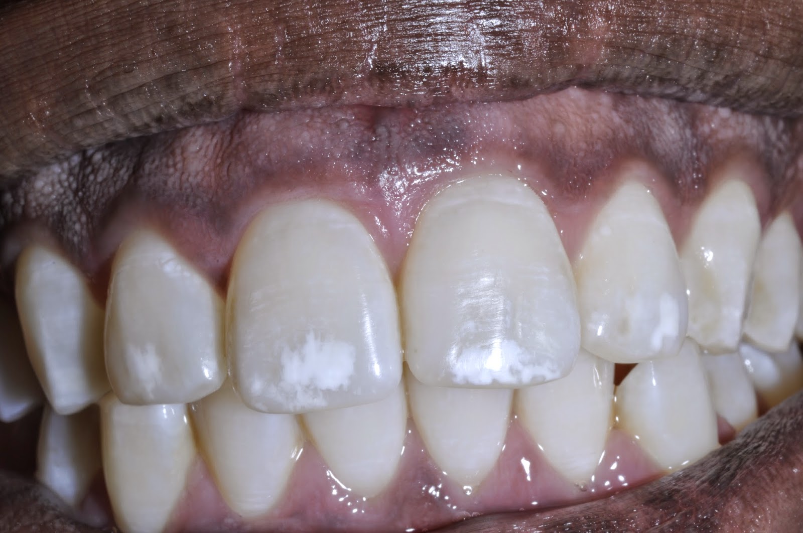 why do you get white spots on your teeth