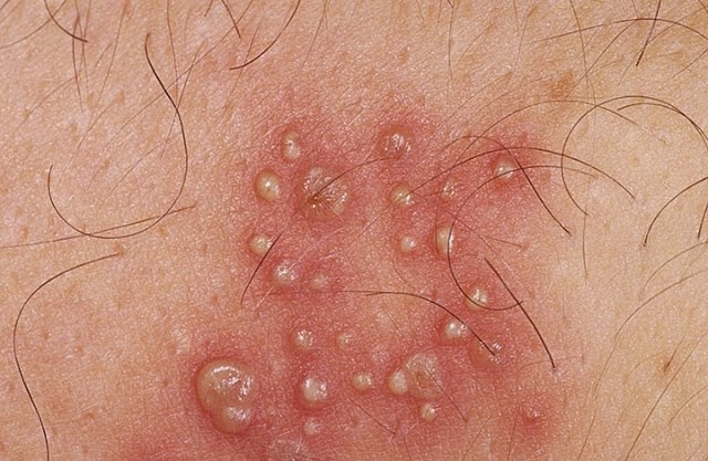 Complete Understanding on How You can Get Genital Herpes