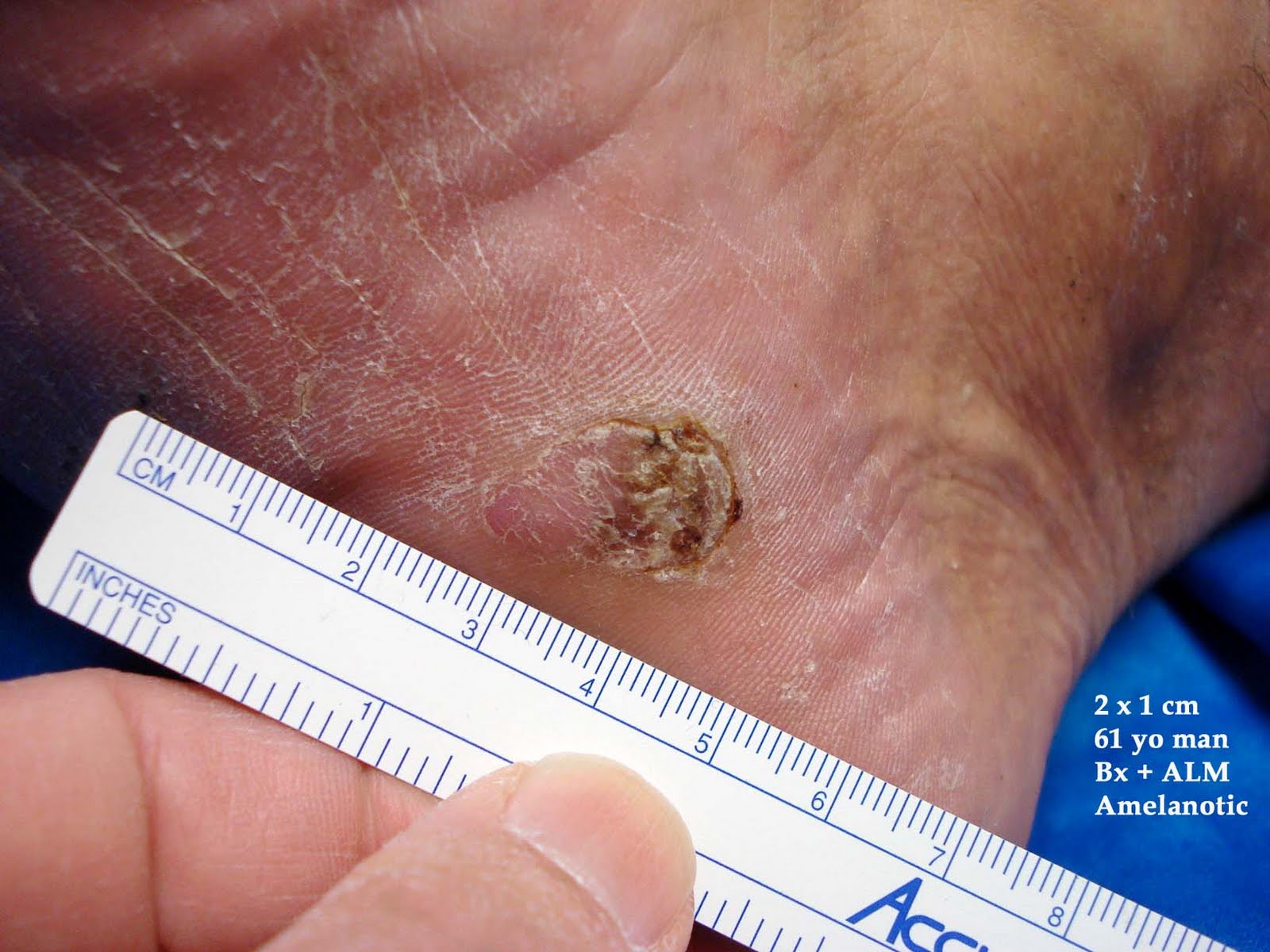 acral lentiginous melanoma