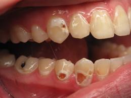 Image result for corroded teeth