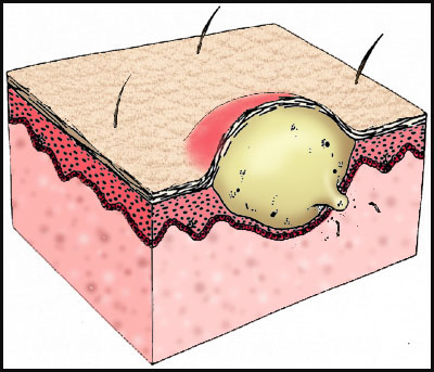 Acne With Pus
