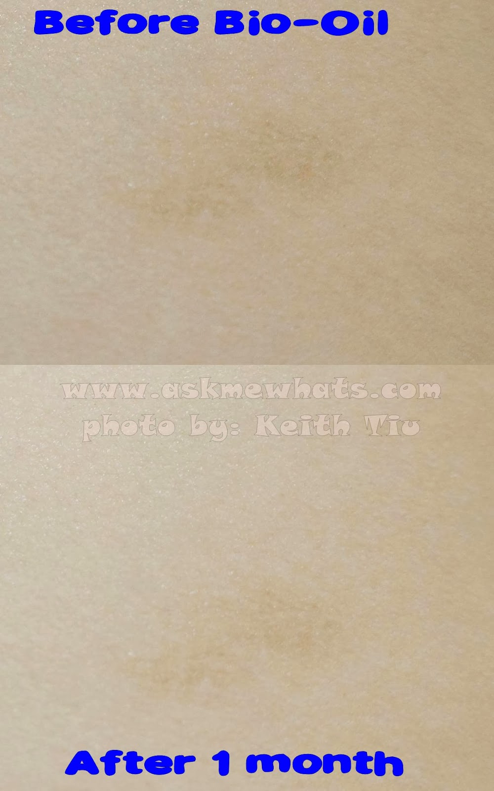 Using Bio Oil Keloid Scar